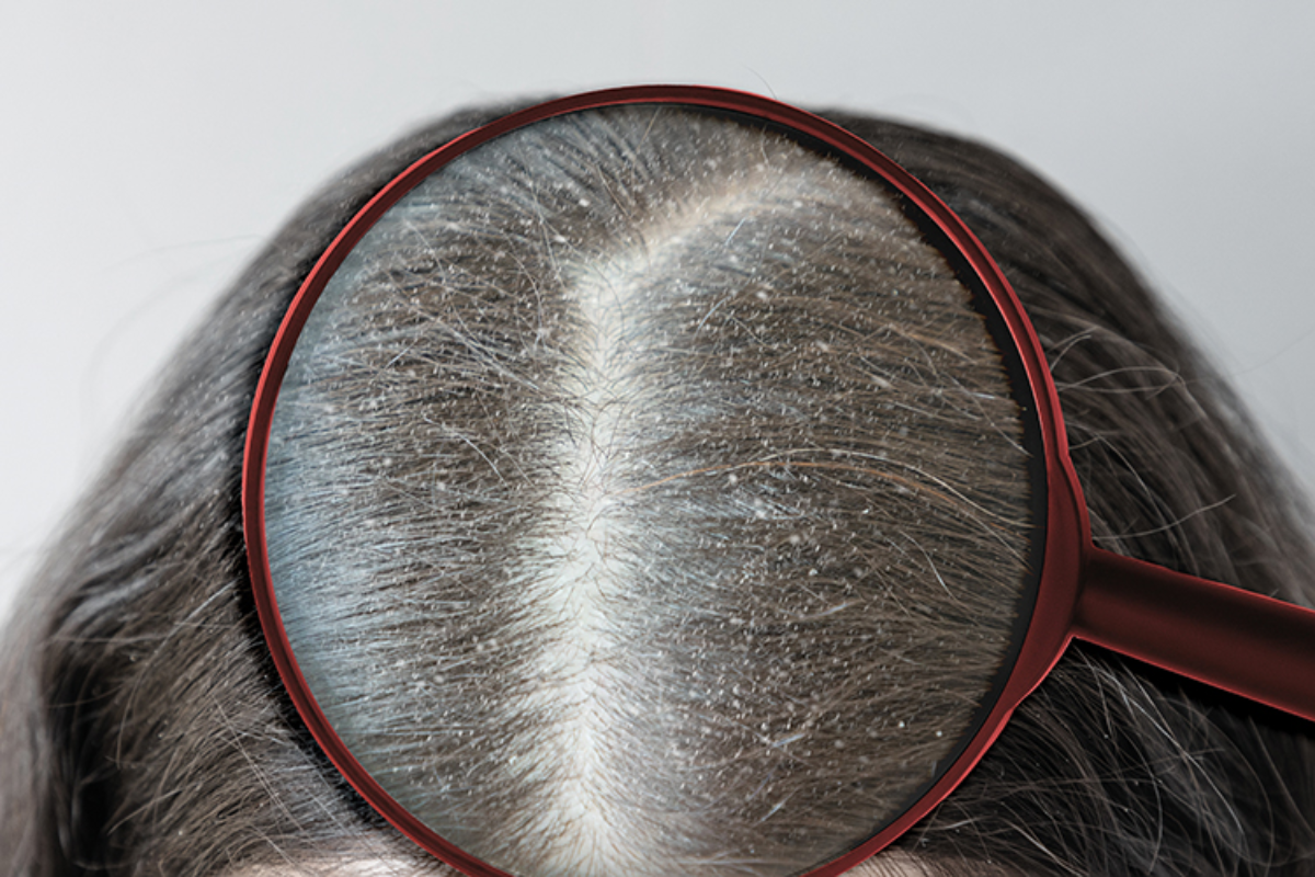 Qué es la Dermatitis Seborreica en el cuero cabelludo?